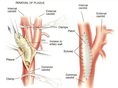 Removal Plaque